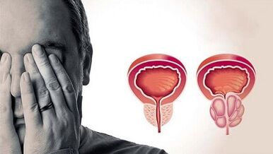 Die Gründe für die Entwicklung von Prostatitis bei Männern