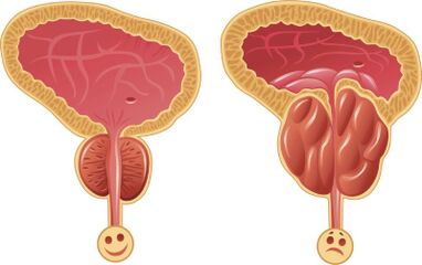 Gesunde und entzündete männliche Prostata