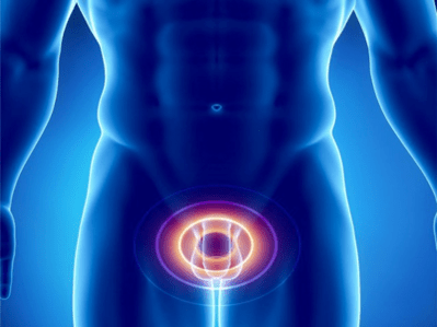 Prostatitis – Entzündung der Prostata beim Mann
