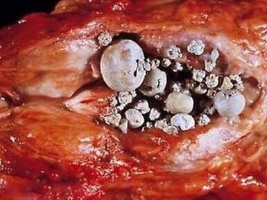 Steine ​​in der Prostata bei kalkhaltiger Prostatitis