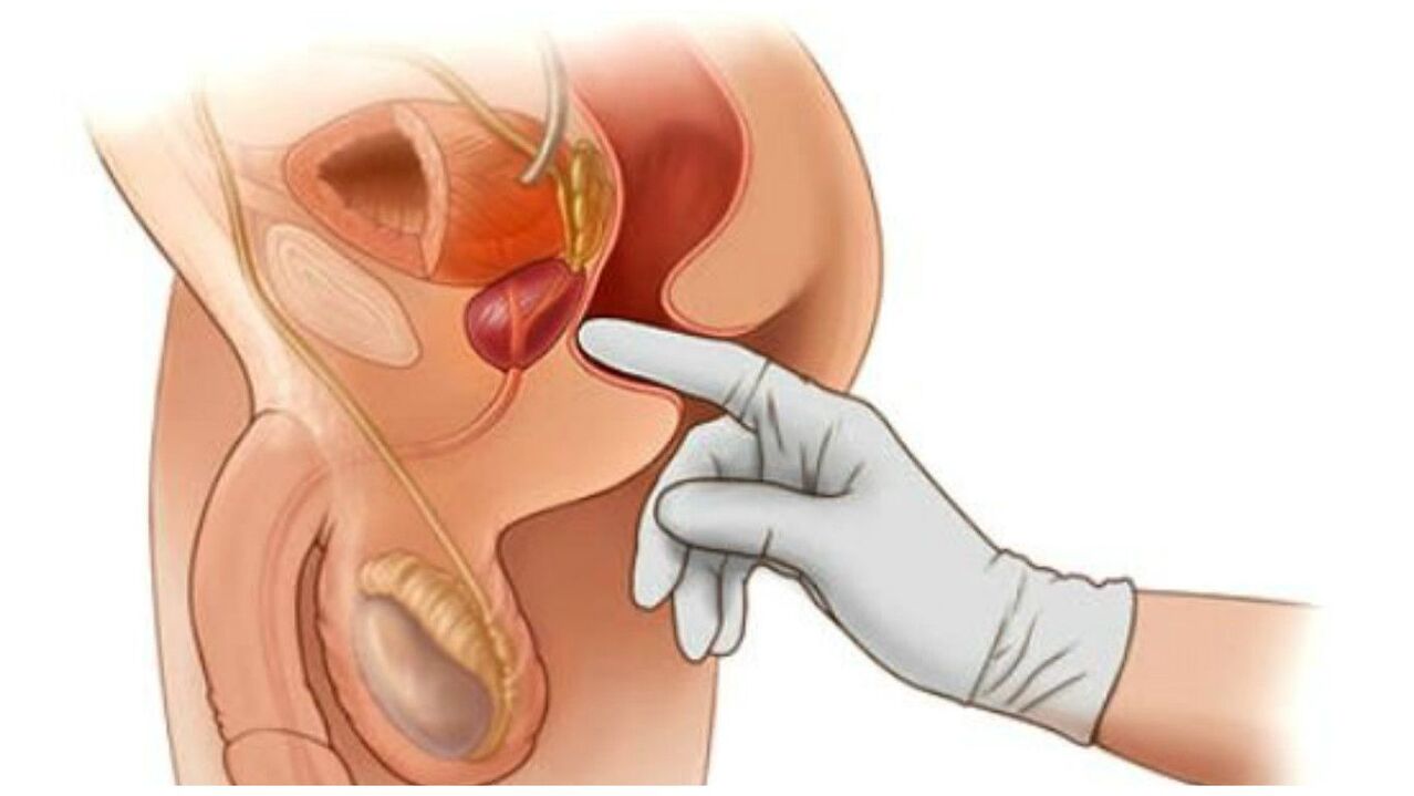 Prostatamassage