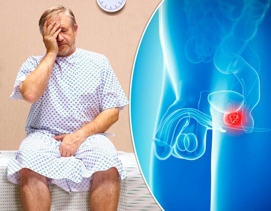 Bei einem Mann mit Prostatitis wird eine Krankheit diagnostiziert